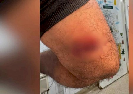 Servidor da saúde é mordido por paciente da UPA que aguardava vaga na psiquiatria da UFGD